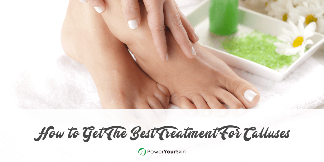 How to Get The Best Treatment For Calluses